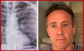 Chris Cuomo and his chest X-ray