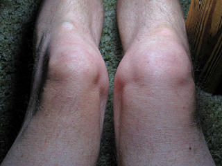 Swollen knee